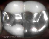 mercury amalgam filling