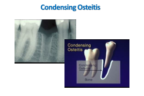 condensing osteitis