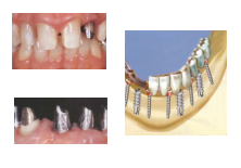 dental implants