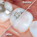 mercury amalgam vs. composite