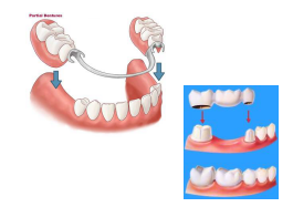 dental partials
