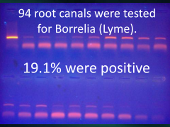 root canals and Lyme