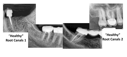 root canal x-rays