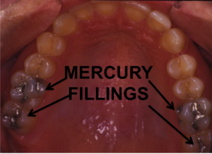 mercury amalgam fillings