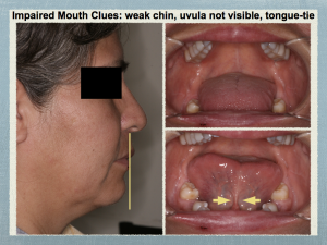 Impaired Mouth clues