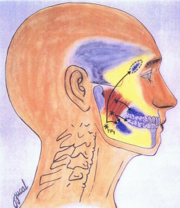 diagram showing masseter trigger point