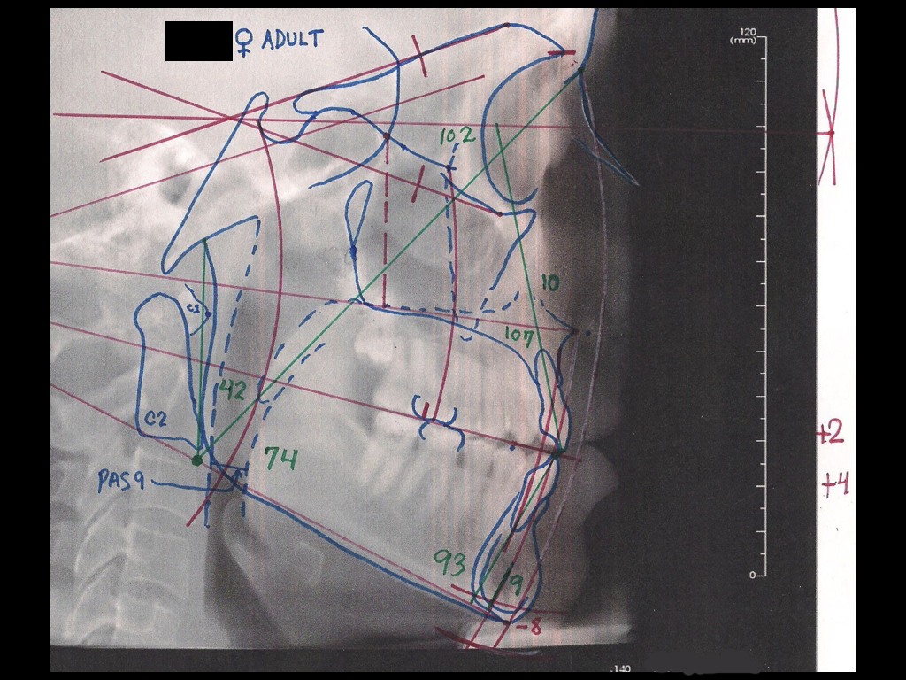 cephalometric analysis