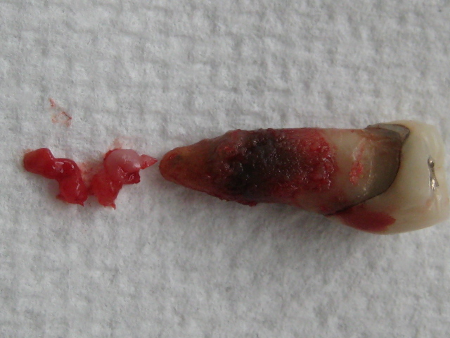 extracted root canal tooth