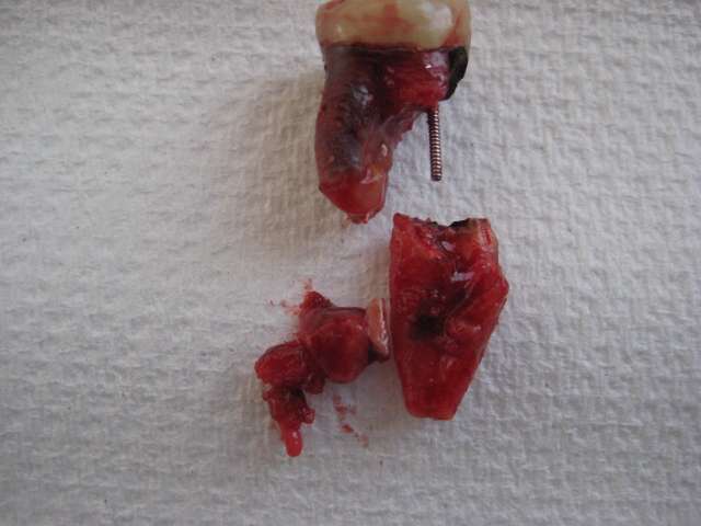 extracted root canal tooth