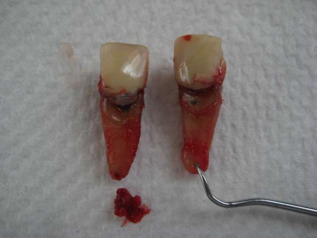 extracted root canal teeth