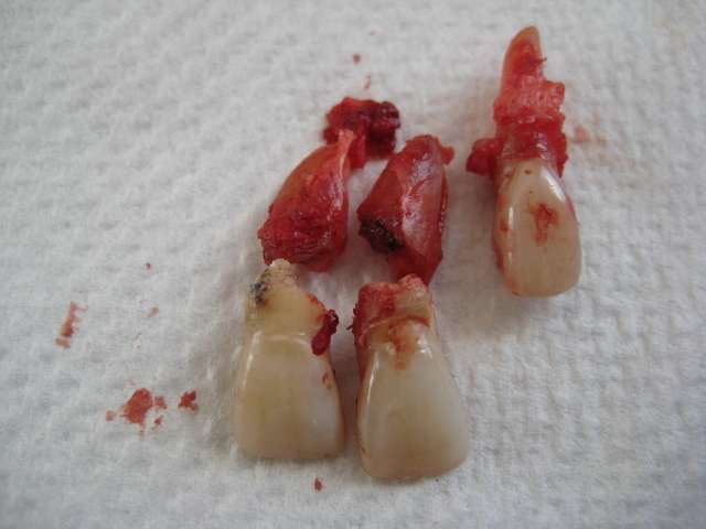 extracted root canal teeth