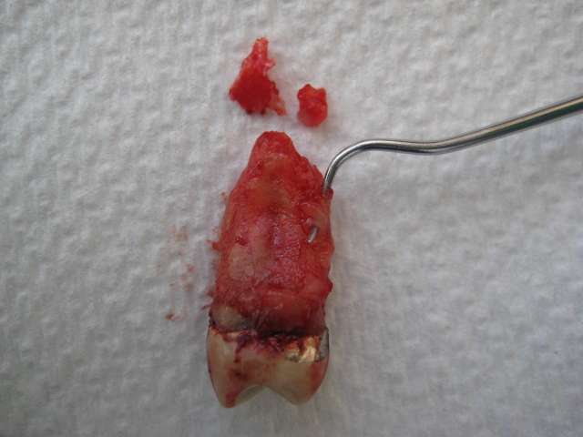 exracted root canal tooth