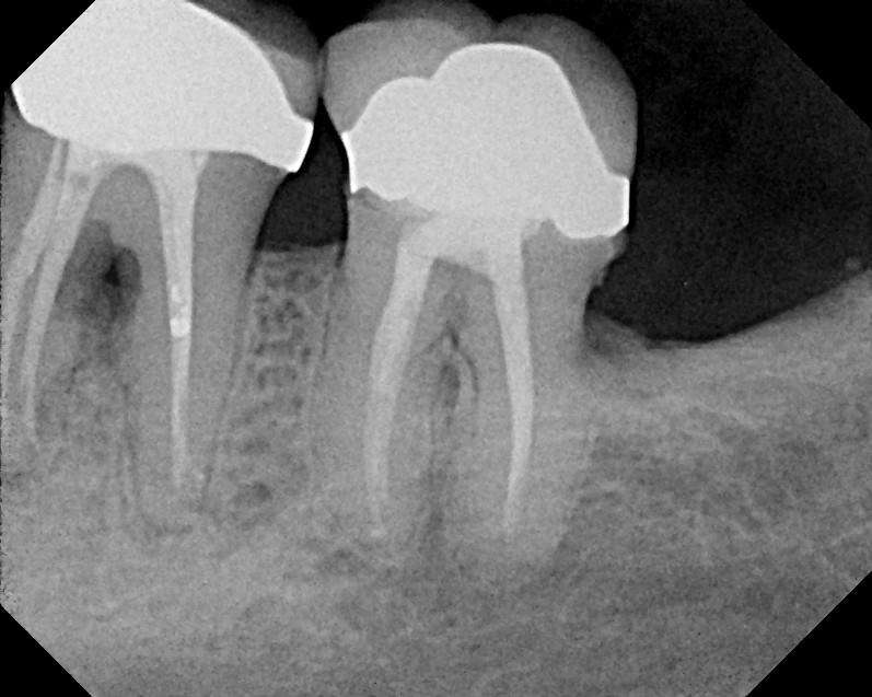 xray of root canal tooth