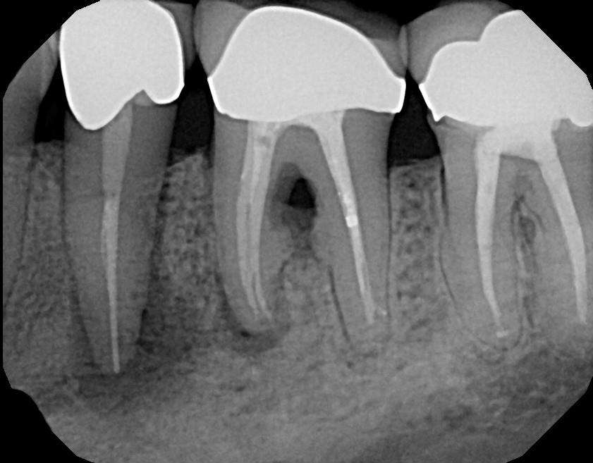 xray of root canal teeth