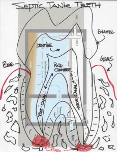 tooth diagrammed over septic tank