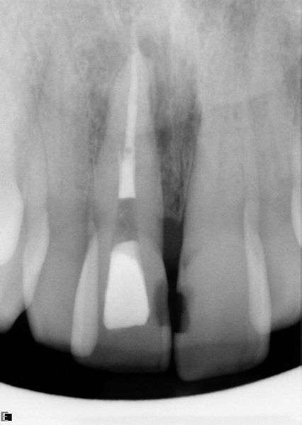 x-ray of tooth with root canal
