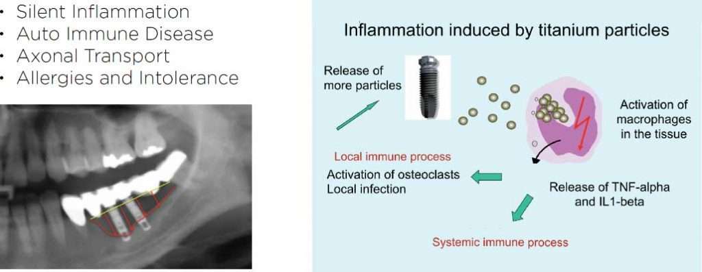 titanium particles inducing inflammation