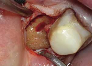 infected root canal tooth