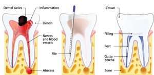 root canal diagram