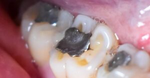 Amalgam Fillings