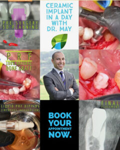 Ceramic Implant Collage RENAME 240x300